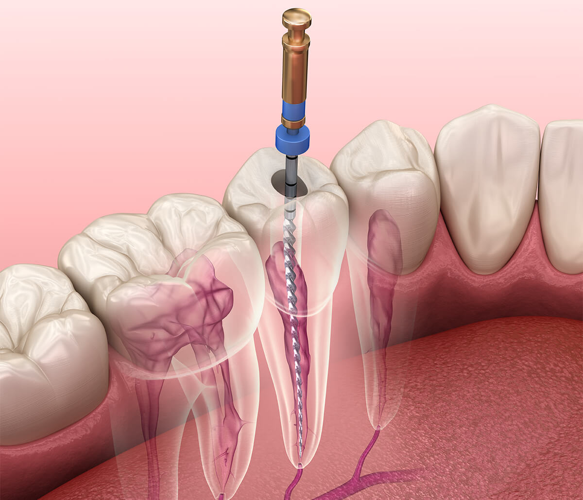 Root Canal Infection Symptoms in Tucson AZ Area